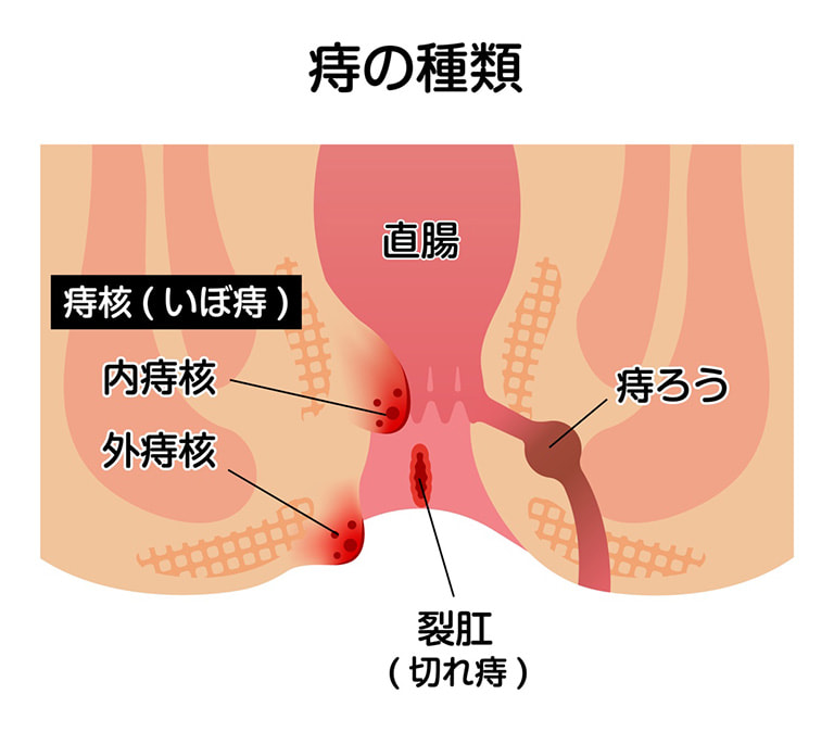 痔の種類